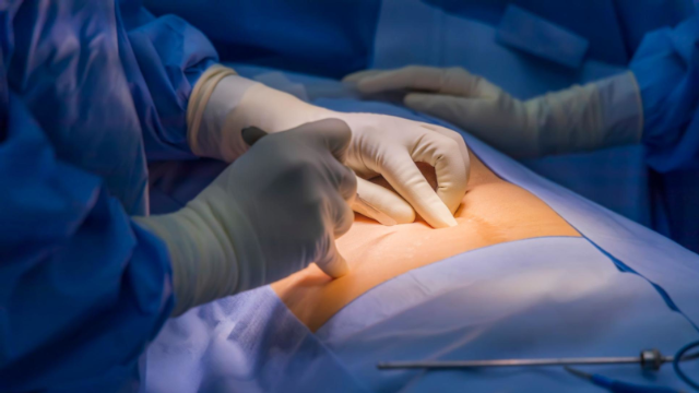 close da mão do cirurgião segurando o bisturi e realizando a incisão no abdômen do paciente